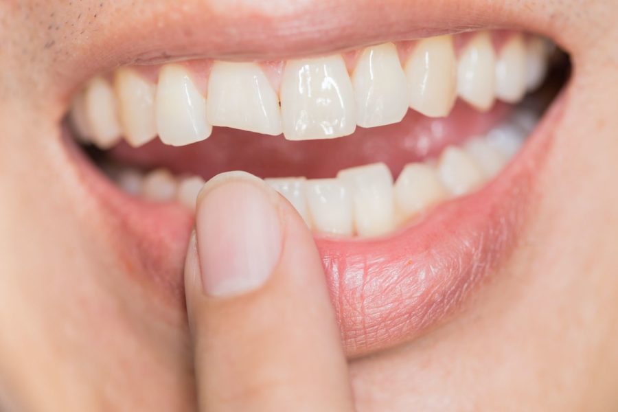 how-to-fix-a-chipped-tooth-dentist-in-marietta-ga